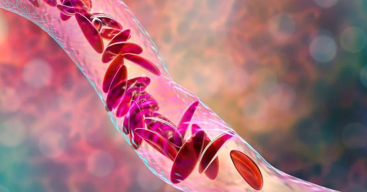 Las células madre genéticamente modificadas ofrecen esperanza contra la anemia de células falciformes