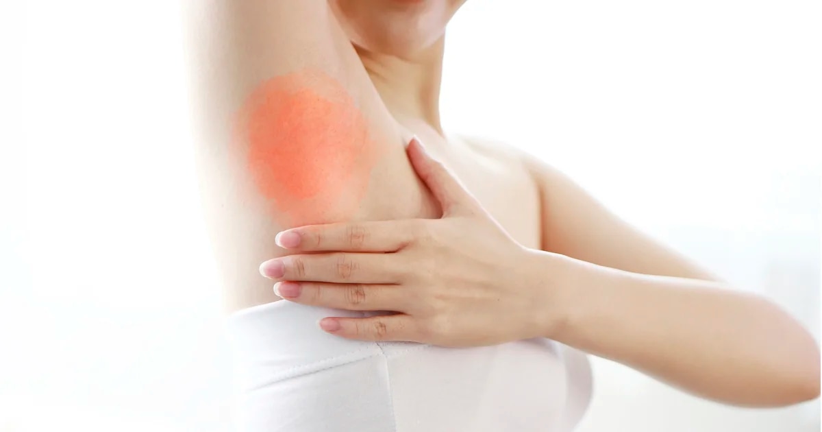 La campaña gratuita para saber si padeces hidradenitis supurativa, una dolorosa enfermedad de la piel